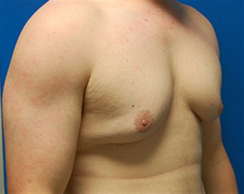 Gynecomastia Before and After | SGK Plastic Surgery