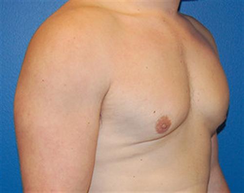 Gynecomastia Before and After | SGK Plastic Surgery