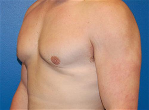 Gynecomastia Before and After | SGK Plastic Surgery