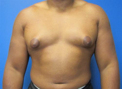 Gynecomastia Before and After | SGK Plastic Surgery