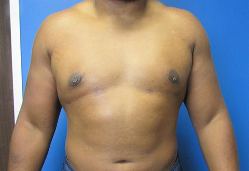 Gynecomastia Before and After | SGK Plastic Surgery