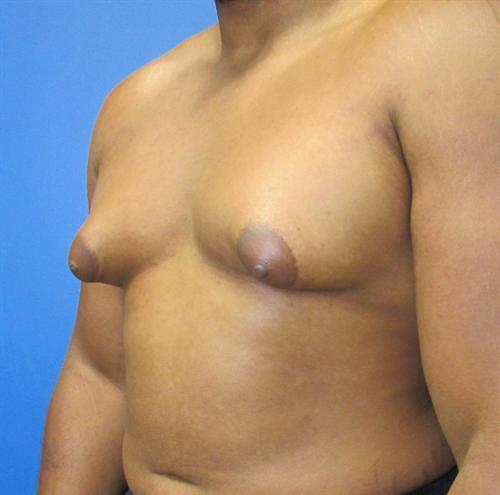 Gynecomastia Before and After | SGK Plastic Surgery