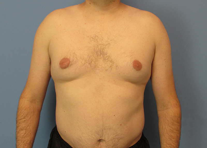 Gynecomastia Before and After | SGK Plastic Surgery