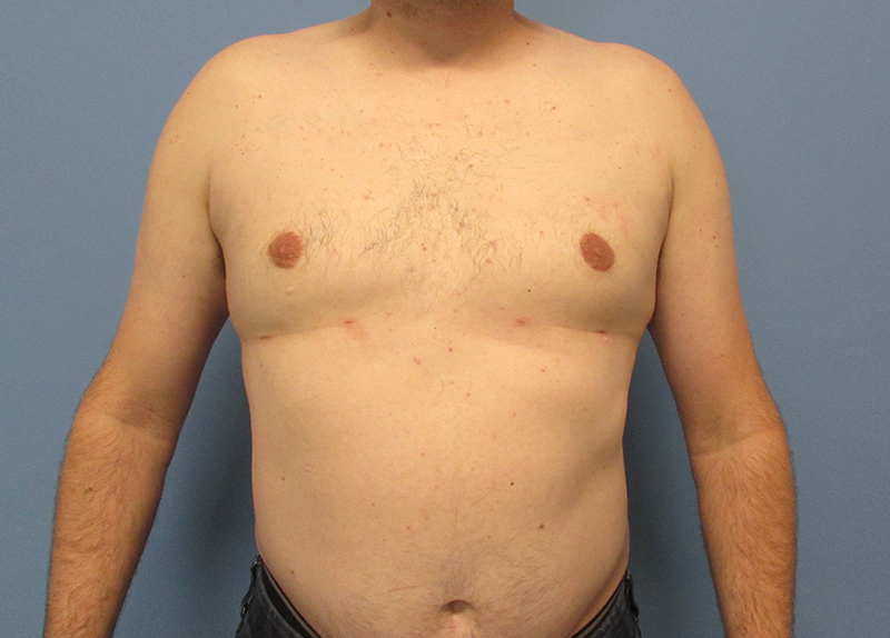 Gynecomastia Before and After | SGK Plastic Surgery