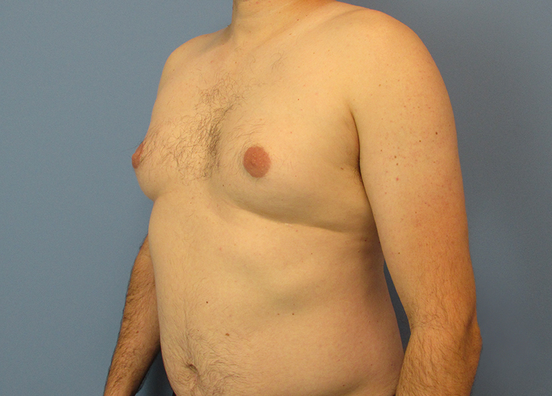 Gynecomastia Before and After | SGK Plastic Surgery