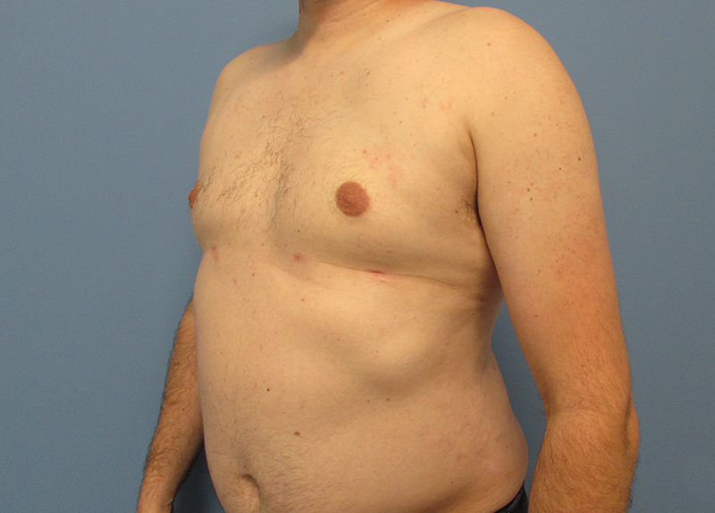 Gynecomastia Before and After | SGK Plastic Surgery