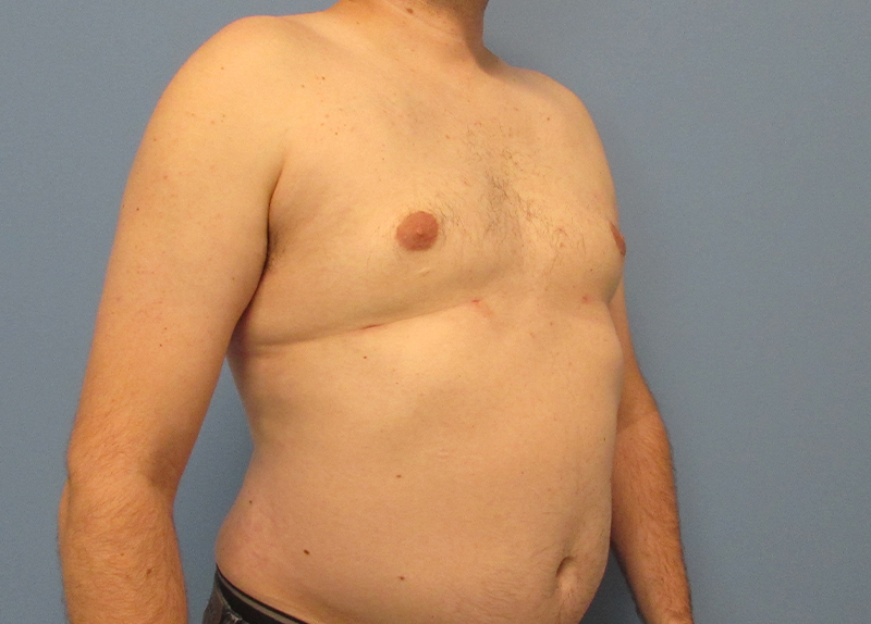 Gynecomastia Before and After | SGK Plastic Surgery