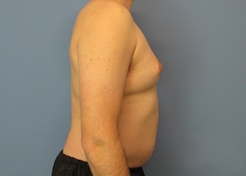 Gynecomastia Before and After | SGK Plastic Surgery