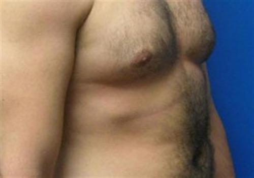 Liposuction For Men Before and After | SGK Plastic Surgery