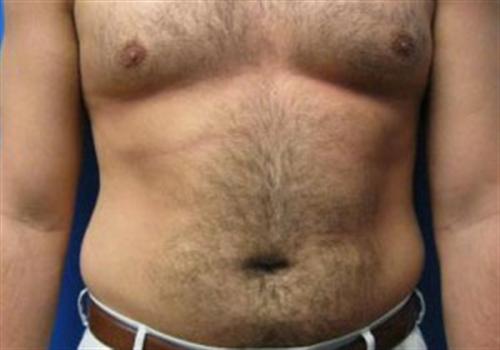 Liposuction For Men Before and After | SGK Plastic Surgery