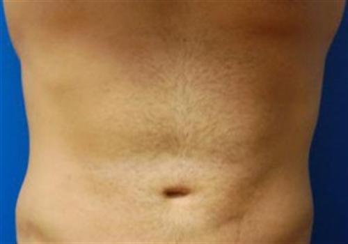 Liposuction For Men Before and After | SGK Plastic Surgery