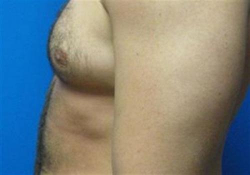 Liposuction For Men Before and After | SGK Plastic Surgery