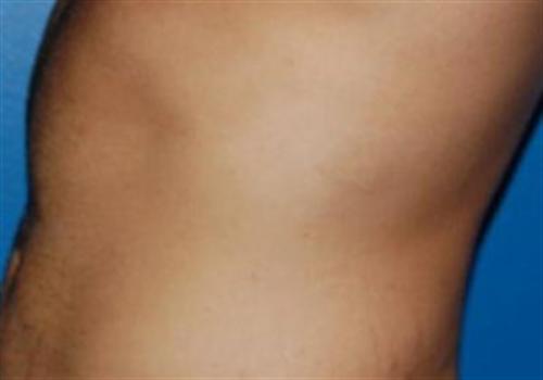Liposuction For Men Before and After | SGK Plastic Surgery