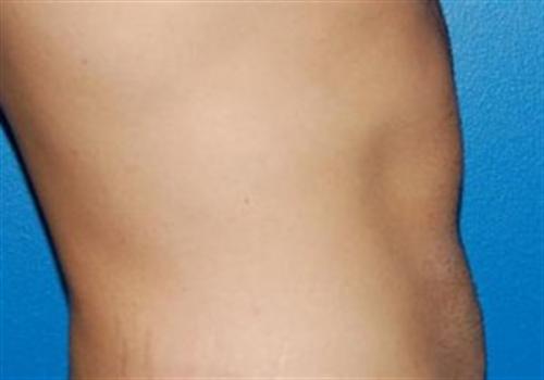 Liposuction For Men Before and After | SGK Plastic Surgery