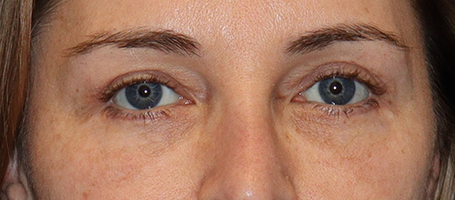 Eyelid Surgery Before and After | SGK Plastic Surgery