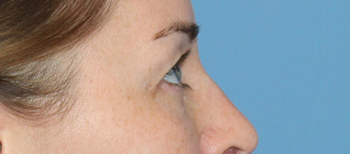 Eyelid Surgery Before and After | SGK Plastic Surgery