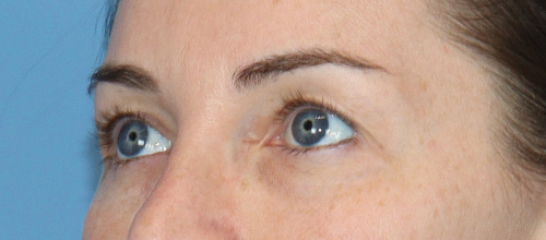 Eyelid Surgery Before and After | SGK Plastic Surgery