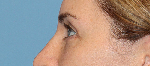 Eyelid Surgery Before and After | SGK Plastic Surgery