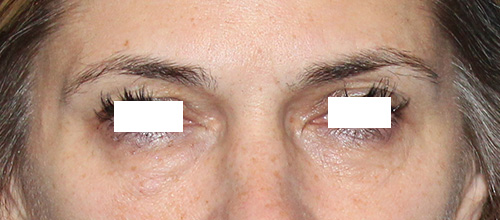 Eyelid Surgery Before and After | SGK Plastic Surgery