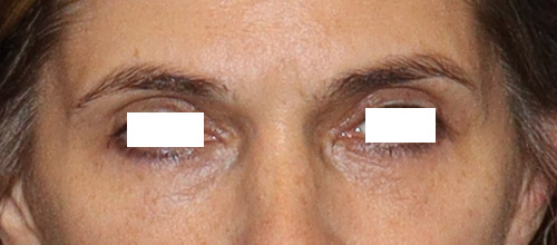 Eyelid Surgery Before and After | SGK Plastic Surgery