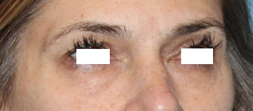 Eyelid Surgery Before and After | SGK Plastic Surgery