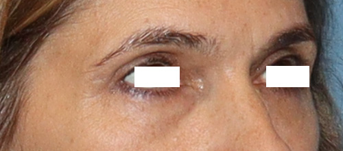 Eyelid Surgery Before and After | SGK Plastic Surgery