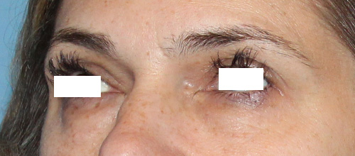 Eyelid Surgery Before and After | SGK Plastic Surgery