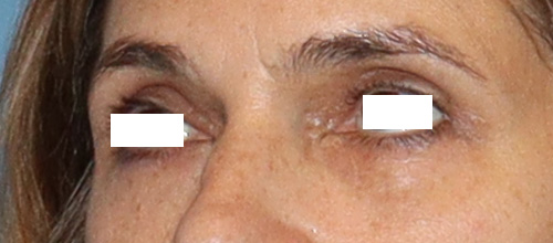 Eyelid Surgery Before and After | SGK Plastic Surgery