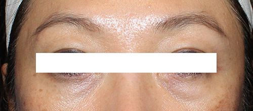 Eyelid Surgery Before and After | SGK Plastic Surgery