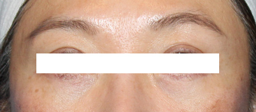 Eyelid Surgery Before and After | SGK Plastic Surgery