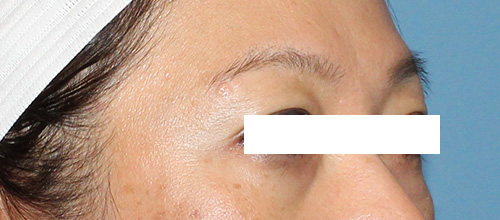 Eyelid Surgery Before and After | SGK Plastic Surgery