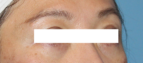 Eyelid Surgery Before and After | SGK Plastic Surgery