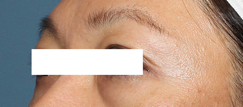 Eyelid Surgery Before and After | SGK Plastic Surgery