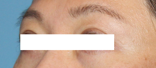 Eyelid Surgery Before and After | SGK Plastic Surgery