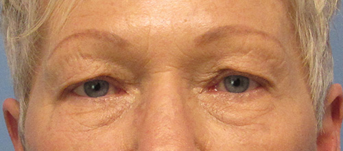 Eyelid Surgery Before and After | SGK Plastic Surgery