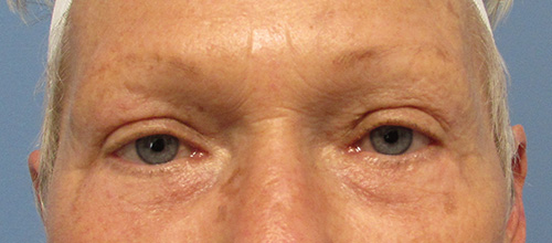 Eyelid Surgery Before and After | SGK Plastic Surgery