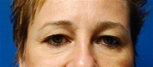 Eyelid Surgery Before and After | SGK Plastic Surgery