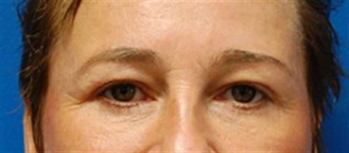 Eyelid Surgery Before and After | SGK Plastic Surgery