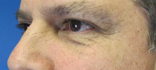 Eyelid Surgery Before and After | SGK Plastic Surgery