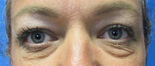 Eyelid Surgery Before and After | SGK Plastic Surgery