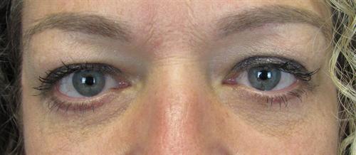 Eyelid Surgery Before and After | SGK Plastic Surgery