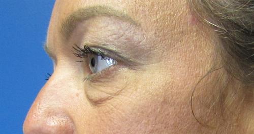 Eyelid Surgery Before and After | SGK Plastic Surgery