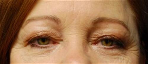 Eyelid Surgery Before and After | SGK Plastic Surgery