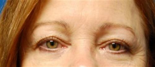 Eyelid Surgery Before and After | SGK Plastic Surgery