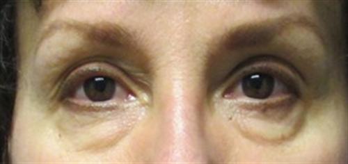 Eyelid Surgery Before and After | SGK Plastic Surgery