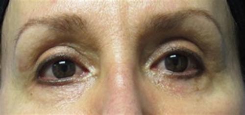 Eyelid Surgery Before and After | SGK Plastic Surgery