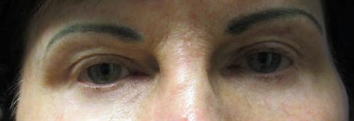 Eyelid Surgery Before and After | SGK Plastic Surgery