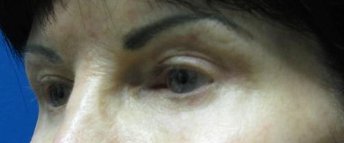 Eyelid Surgery Before and After | SGK Plastic Surgery