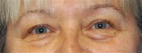 Eyelid Surgery Before and After | SGK Plastic Surgery