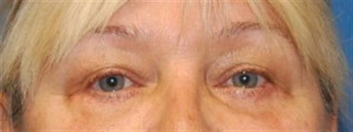 Eyelid Surgery Before and After | SGK Plastic Surgery